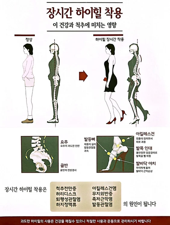 장시간 하이힐 착용이 척추에 미치는 영향